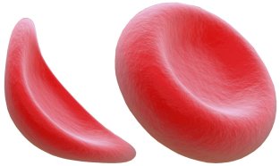sickle cell anemia.jpg